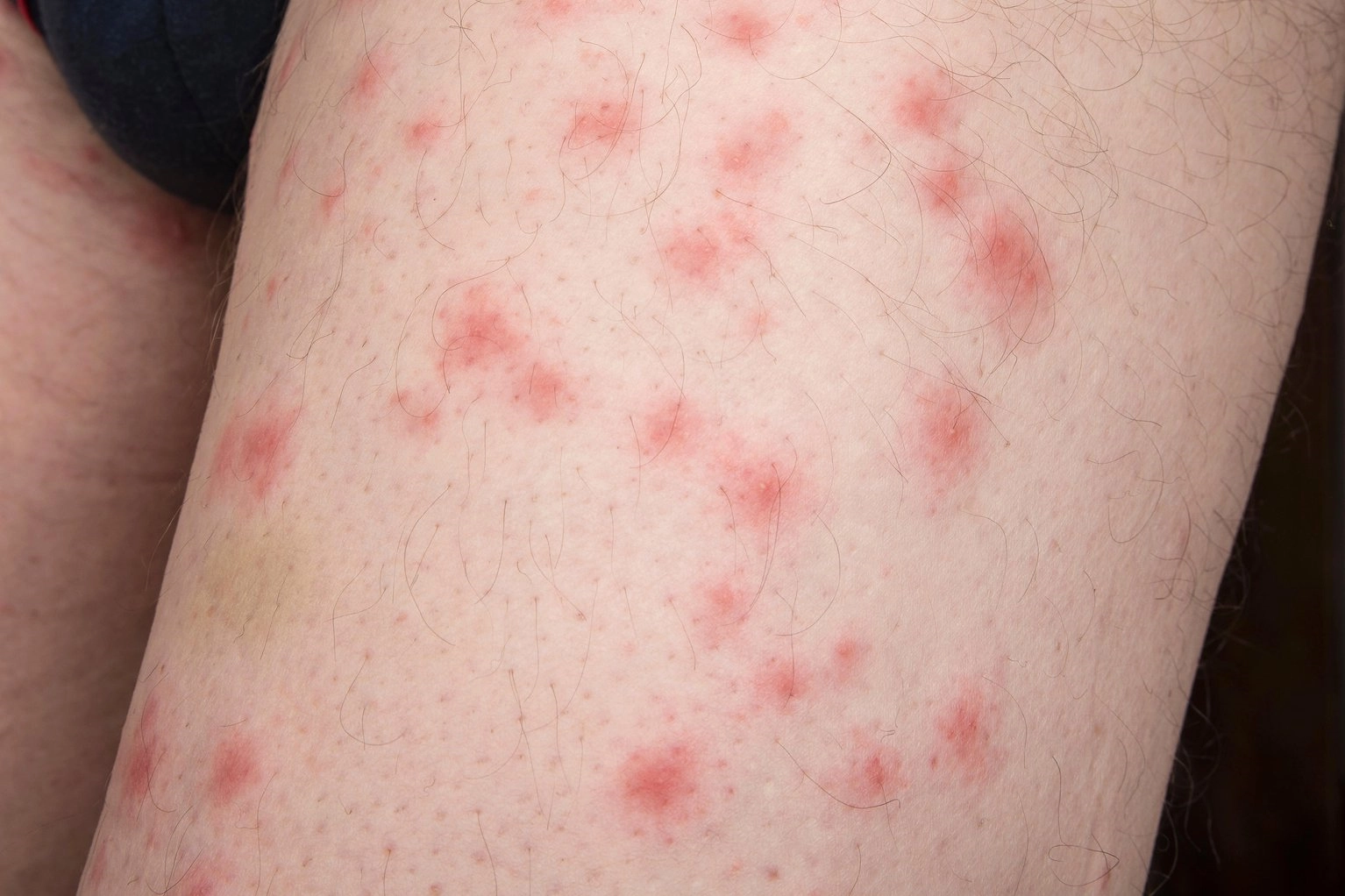 A cluster of red bedbug bites as seen on skin image of a cluster of bed bug bites on pale skin